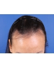 Before Hair Transplant&nbsp;Hairline